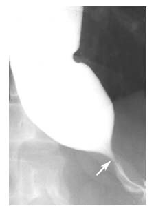 Barium swallow shows narroowing 